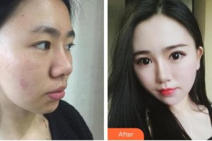 昆明韓辰整形醫(yī)院周楊洋整形價格表附內(nèi)切祛眼袋案例展示