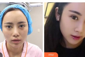 昆明市第一人民醫(yī)院星耀醫(yī)院杜海寬整形價格表附切開雙眼皮案例展示