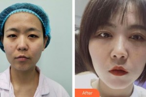 昆明前衛(wèi)美眼整形?？圃\所夏玲整形價格表附眼部綜合案例展示