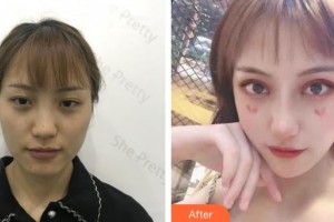 昆明前衛(wèi)美眼整形?？圃\所吳瓊整形價格表附切開雙眼皮案例展示