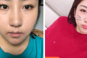 昆明美立方（原大華）醫(yī)療美容醫(yī)院晉超整形價格表附切開雙眼皮案例展示