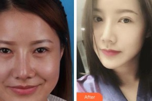 昆明美立方（原大華）醫(yī)療美容醫(yī)院劉鳳斌整形價格表附切開雙眼皮案例展示