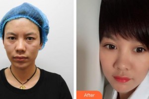 昆明韓辰整形醫(yī)院邢志英整形價格表附切開雙眼皮案例展示