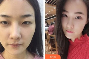 昆明璀璨人生醫(yī)療美容診所時保義整形價格表附開外眼角案例展示