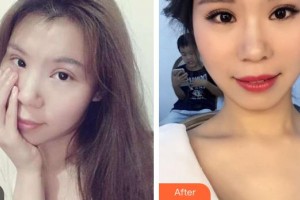 昆明璀璨人生醫(yī)療美容診所李德平整形價格表附皮切開雙眼皮案例展示