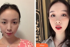 昆明同仁醫(yī)院醫(yī)療美容科黃玉華整形價格表附眼部綜合案例展示