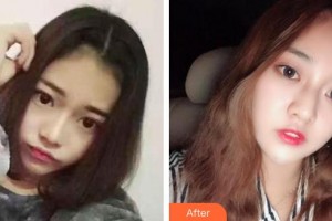 昆明同仁醫(yī)院醫(yī)療美容科李淵整形價格表附眼部修復(fù)案例展示