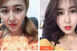 昆明卓星美容醫(yī)院劉廷整形價格表附埋線雙眼皮案例展示