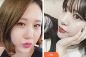 昆明璽蘭醫(yī)療美容診所王卓整形價(jià)格表附開外眼角案例展示