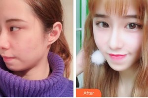 昆明華山眼科醫(yī)院李蘊(yùn)秀整形價(jià)格表附切開雙眼皮案例展示