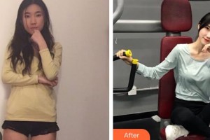 昆明海峽整形美容醫(yī)院趙根云整形價格表附玻尿酸精華導(dǎo)入案例展示