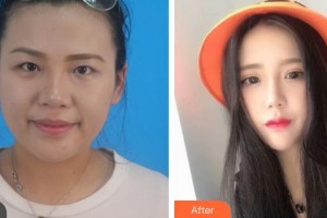 昆明醫(yī)科大學第二附屬醫(yī)院整形外科王繼華整形價格表附切開雙眼皮案例展示