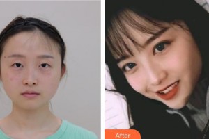 昆明醫(yī)科大學(xué)第二附屬醫(yī)院整形外科肖敏勤整形價格表附切開雙眼皮案例展示