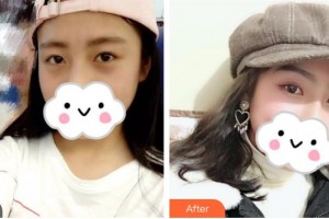 昆明醫(yī)科大學(xué)第二附屬醫(yī)院整形外科戴榮琴整形價格表附眼部綜合案例展示