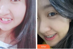 昆明醫(yī)科大學(xué)第一附屬醫(yī)院整形外科代曉明整形價(jià)格表附金屬托槽矯正案例展示