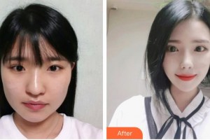 昆明醫(yī)科大學(xué)第二附屬醫(yī)院整形外科朱禮昆整形價(jià)格表附眼部綜合案例展示