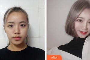 昆明華山眼科醫(yī)院徐慧整形價(jià)格表附切開雙眼皮案例展示