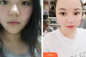 昆明愛爾眼科醫(yī)院黃廷剛整形價格表附眼部案例展示