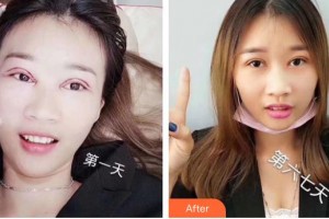 昆明愛爾眼科醫(yī)院楊建宇整形價格表附眼部綜合案例展示