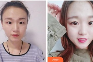 昆明愛爾眼科醫(yī)院徐彬整形價格表附切眉術(shù)例展示