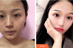 昆明華山眼科醫(yī)院袁天國整形價格表附切開雙眼皮案例展示