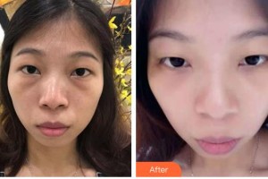 昆明華山眼科醫(yī)院謝伯林整形價格表附激光去眼袋案例展示