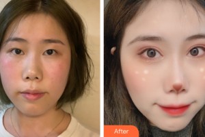 南寧熠美醫(yī)療美容診所徐贊正整形價(jià)格表附雙眼皮手術(shù)案例展示