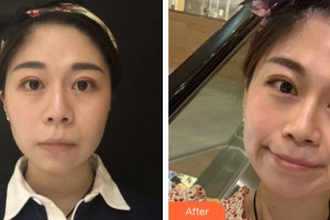 南寧悅美韓星醫(yī)療整形美容醫(yī)院陳俊武整形價格表附瘦臉案例展示