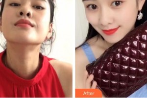 昆明普瑞眼科醫(yī)院范光忠整形價格表附切開雙眼皮案例展示