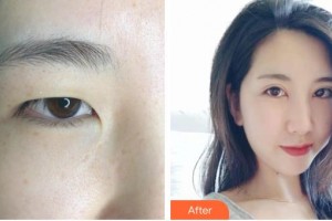 昆明普瑞眼科醫(yī)院錢婷整形價格表附眼部綜合案例展示