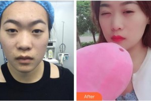 昆明普瑞眼科醫(yī)院何守科整形價格表附定點(diǎn)雙眼皮案例展示