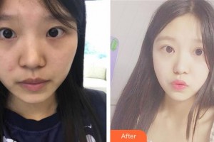 昆明愛爾眼科醫(yī)院高雪嬌住院醫(yī)師整形價格表附定點(diǎn)雙眼皮案例展示