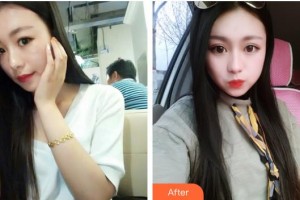 昆明普瑞眼科醫(yī)院張煜宸整形價格表附切開雙眼皮案例展示