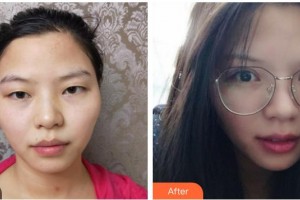 昆明愛爾眼科醫(yī)院甘凌整形價格表附眼部綜合價格表