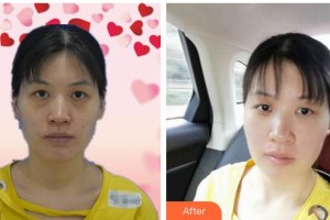 昆明康特森眼科醫(yī)院喬彤整形價格表附眼部綜合價格表