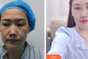 東南大學(xué)附屬中大醫(yī)院整形外科章慶國整形價格表附外切祛眼袋案例展示