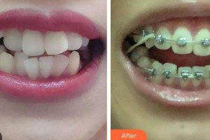 張前整形價格表附金屬托槽矯正案例展示