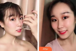 儲志強(qiáng)整形價格表附牙齒隱形矯正案例展示