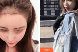 武漢中翰整形外科醫(yī)院崔正根整形價格表附植發(fā)案例展示