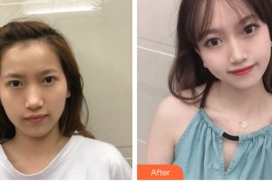 武漢中翰整形外科醫(yī)院程翠蘭整形價格表附自體脂肪填充案例展示