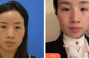 昆明市延安醫(yī)院杰西艾美容醫(yī)院張四文教授整形價格表附激光去眼袋案例展示