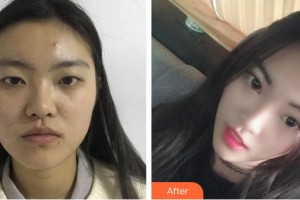 昆明阿瑪施眼科門診部翟國光整形價格表附切開雙眼皮案例展示