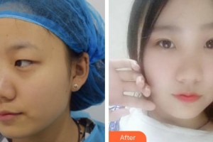 昆明阿瑪施眼科門診部姜耀和整形價格表附定點(diǎn)雙眼皮案例展示