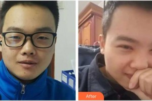 昆明眼科醫(yī)院字王雄整形價格表附開內(nèi)眼角案例展示