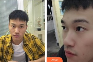 昆明康特森眼科醫(yī)院盧海整形價格表附下瞼整形案例展示