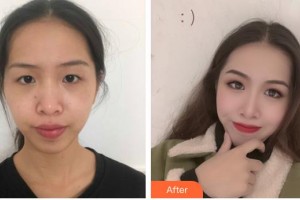 昆明康特森眼科醫(yī)院何彥明整形價格表附眼部綜合案例展示