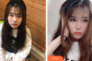 昆明康特森眼科醫(yī)院何玉清整形價格表附切開雙眼皮案例展示