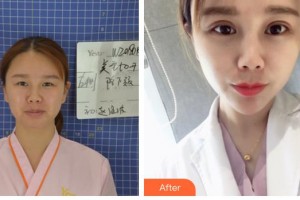 昆明眼科醫(yī)院任佑仁整形價格表附眼部綜合案例展示