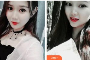 昆明拜博口腔醫(yī)院劉春雷整形價格表附牙齒隱形矯正案例展示