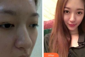 昆明眼科醫(yī)院詹行楷整形價格表附切開雙眼皮案例展示